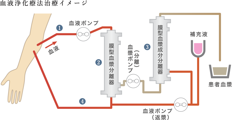 血液浄化療法治療イメージ